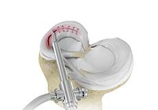 Meniscal Surgery